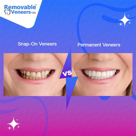 Removable Veneers: A Convenient and Affordable Solution in the United States | Removable Veneers USA