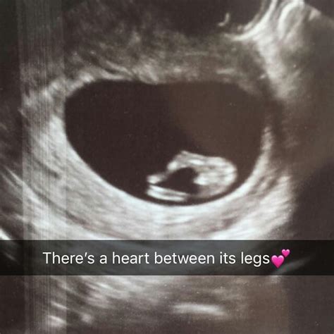 10 week ultrasound - Winnie