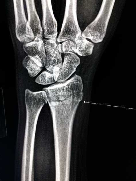 Xray Definition Types Of Xrays Broken Bones Xray