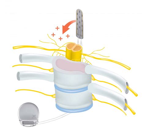Advantages and Disadvantages of Spinal Cord Stimulation