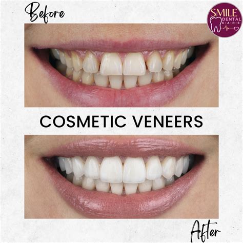 Cosmetic Veneers - Smile Dental Care