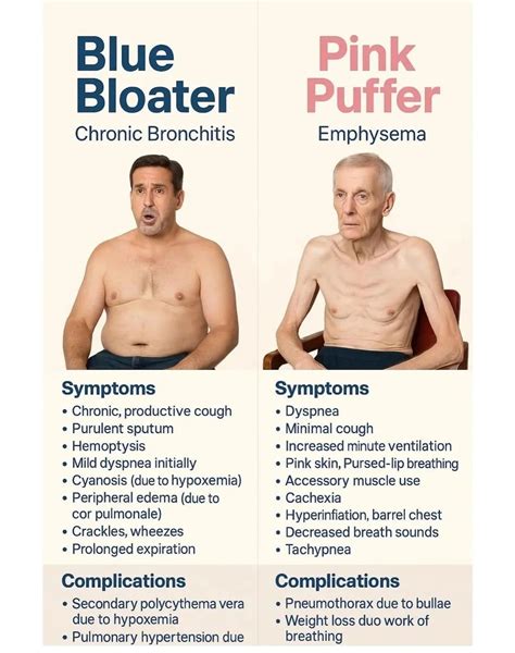Why "blue bloater" and "pink puffer" are outdated terms for COPD ...