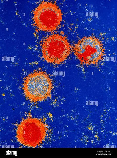 Epstein-Barr viruses, EBV. Coloured transmission electron micrograph of Epstein-Barr viruses in ...