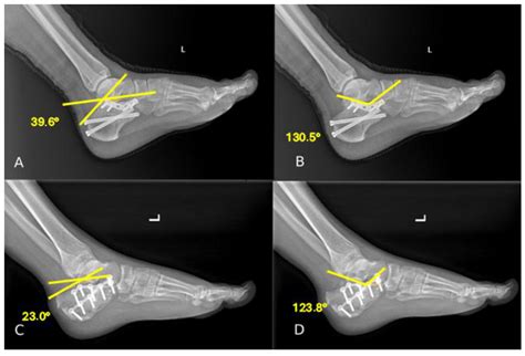 Sinus Tarsi Versus Extensile Lateral Approach for Sanders Type II–IV ...