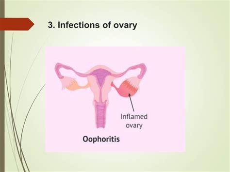 Image result for Female Reproductive System Disorders