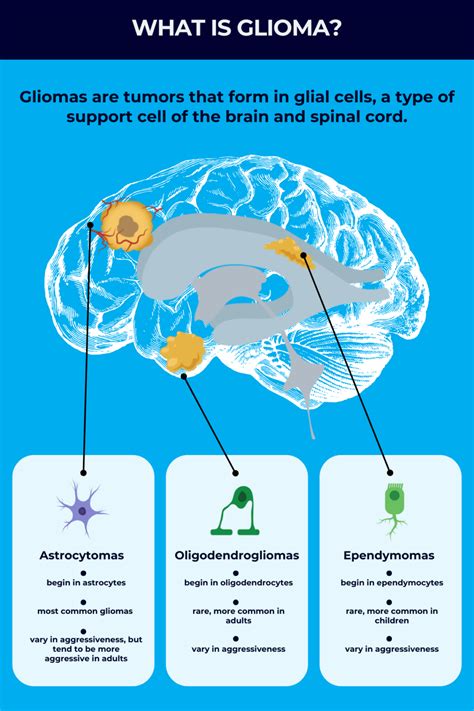 Glioma: Causes, symptoms, and outlook | Rare Cancer News
