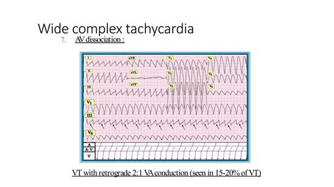 wide complex tachycardia.pptx