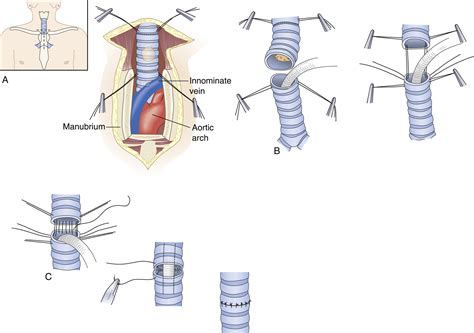 Thoracic surgery techniques in open tracheal surgery for tracheal stenosis - Operative ...
