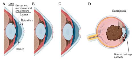 Microbial Adherence to Contact Lenses and Pseudomonas aeruginosa as a ...