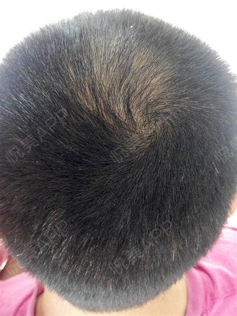 植发大约有140天了，看了下4个月到5个月植发的状态，...头部毛发种植_悦美整形