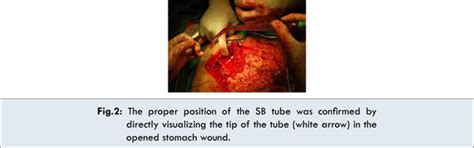 Successful Intraoperative Resuscitation following Upper ...