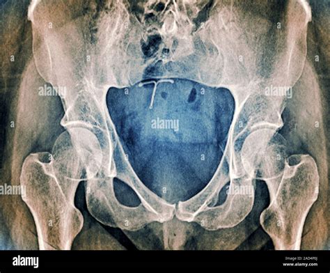 Sacrum And Coccyx X Ray