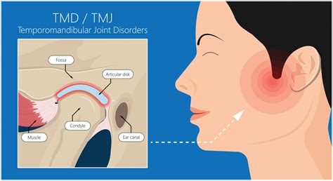 TMJ Chandler & San Tan Valley AZ | TMJ Disorders | TMJ Pain