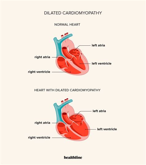 Enlarged Heart Compared To Normal Heart