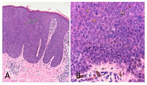 Correlations between Histopathological and Confocal Reflectance ...