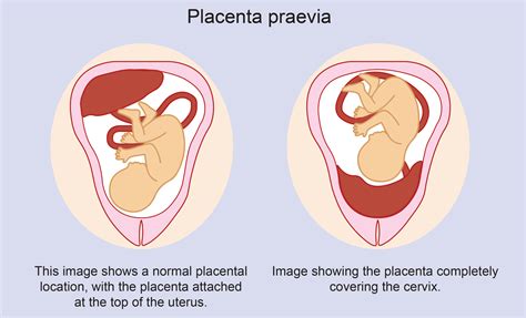 Placenta Accreta Vs Normal Placenta