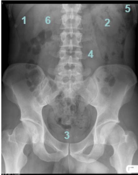 Normal abdomen anatomy on X-ray- labelled Diagram | Quizlet