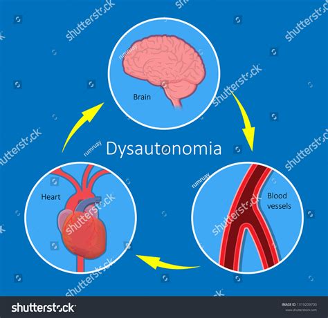 Postural Orthostatic Tachycardia Syndrome Pots Intolerance Stock Vector ...