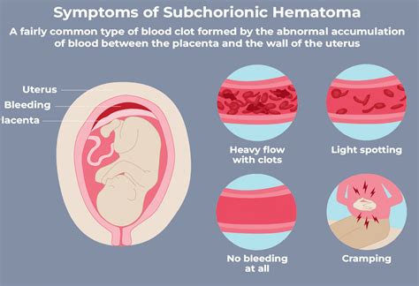 Subchorionic Hematoma Bleeding