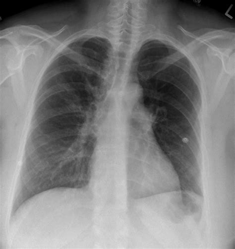Chest X Ray Pulmonary Embolism at Makayla Hampton blog