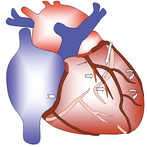 Dual Left Anterior Descending Coronary Artery: CT Findings | AJR