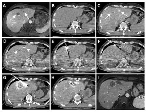 The Added Value of Transcatheter CT Hepatic Angiography (CTHA) Image ...
