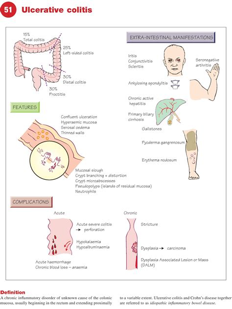 What Triggers Ulcerative Colitis