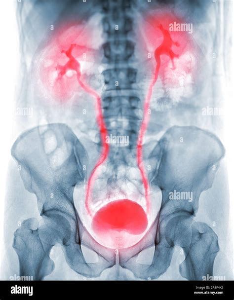 Image result for Normal Intravenous Pyelogram