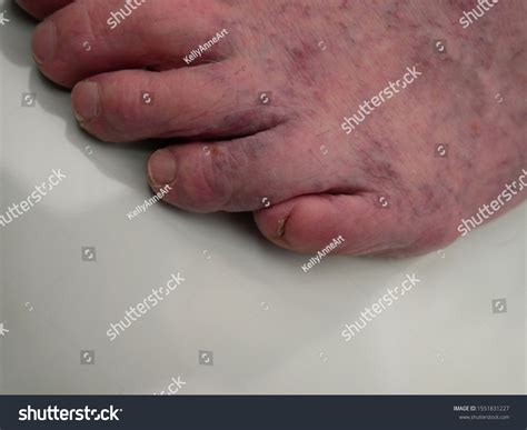 Male Feet Showing Mottled Skin Livedo Stock Photo 1551831227 | Shutterstock