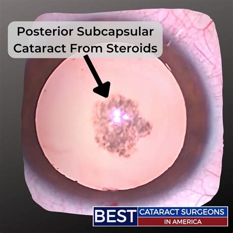 Posterior Subcapsular Cataract