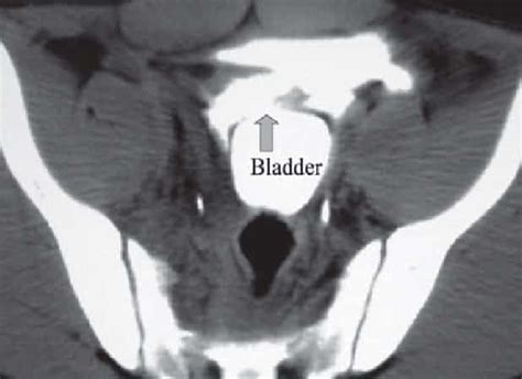 Image result for Bladder Explode