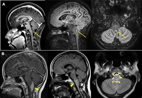 The Etiology and Outcome of Area Postrema Syndrome in Childhood: Two Cases and a Literature ...