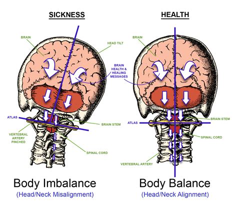 3 Reasons for Straightening of the Cervical Spine & Health