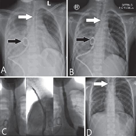 Dilation Of Esophagus