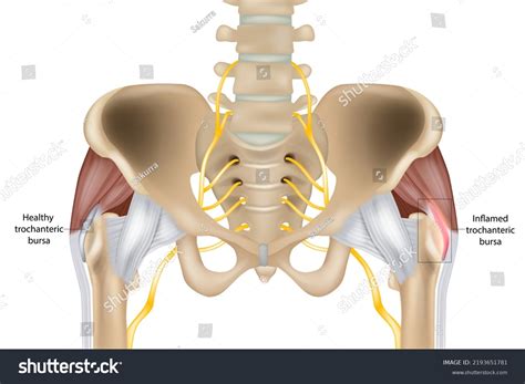 Hip Trochanteric Bursitis Inflammation Bursa Illustration Stock Vector (Royalty Free) 2193651781 ...