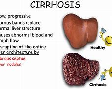 cirrhosis 的图像结果
