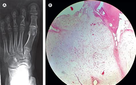 Painful Lump Under Middle Toe at Samantha Mcwhae blog