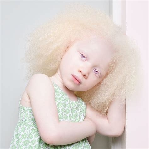 Beautiful People With Albinism