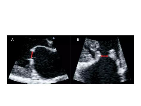 Echocardiography in mitral stenosis | PPTX