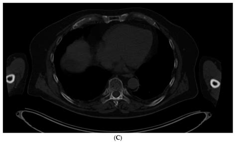 Imaging of Monoclonal Gammapathy of Undetermined Significance and ...