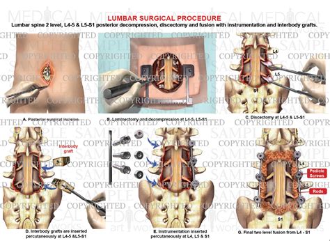 2 level - L4, L5, S1 Posterior lumbar interbody fusion, decompression ...