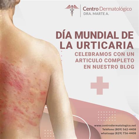 Urticaria: Más que una Picazón en la Piel - Centro Dermatológico Dra ...