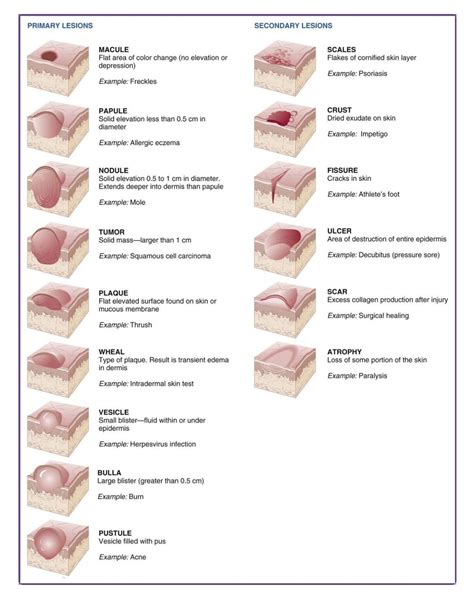 Macule Vs Papule