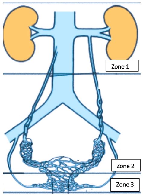 Diagnosis and Management of Pelvic Venous Disorders in Females