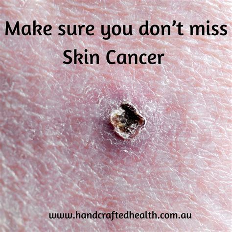 Identify Signs of Skin Cancer The ABCDE acronym can help distinguish a superficial spreading ...