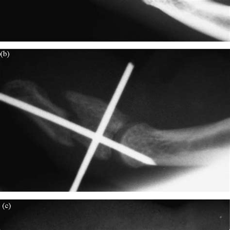 Image result for Leddy Packer Classification Table