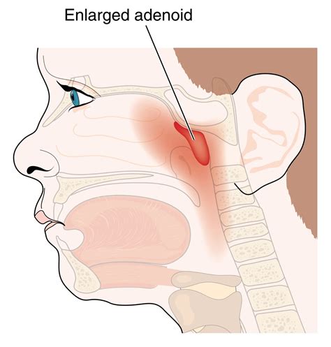 Will Adenoids Grow Back