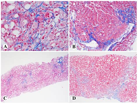 Exosomal microRNAs and Progression of Nonalcoholic Steatohepatitis (NASH)