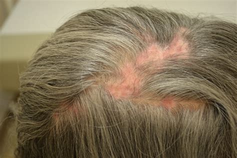 Types of Scarring Alopecia