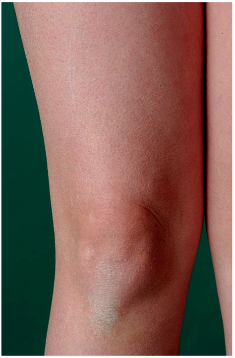Ichthyoses—A Clinical and Pathological Spectrum from Heterogeneous ...